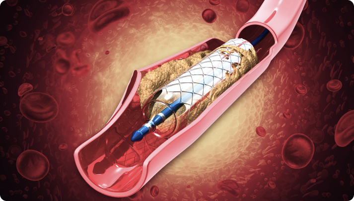 Angioplasty treatment in Singapore
