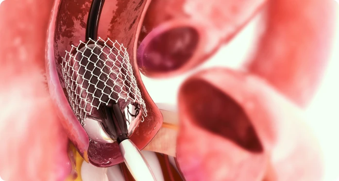 Coronary angiogram procedure in Singapore Coronary angiogram procedure in Singapore