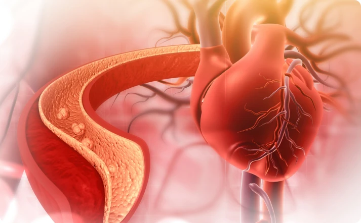 Narrowing coronary arteries Narrowing coronary arteries